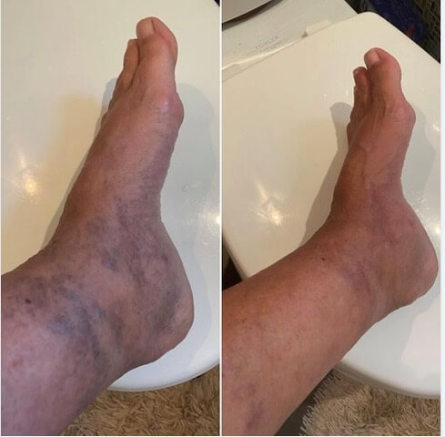 Before and after photos showing the improvement in Beth Greer's old soccer injury from a severe kick to her lower leg and foot after using LifeWave® stem cell activation patches for three months. Before photo on left showing Beth's inflamed lower leg and foot filled with masses of varicose veins. On the right, the After photo showing significant reductions in swelling and masses of varicose veins after using the LifeWave X39® patches.
